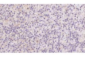 ABIN6273093 at 1/100 staining Human lymph cancer tissue by IHC-P. (BBS7 抗体  (Internal Region))