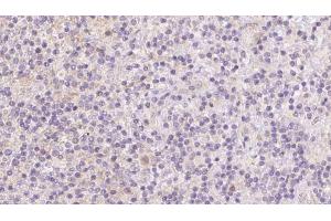ABIN6273093 at 1/100 staining Human lymph cancer tissue by IHC-P. (BBS7 抗体  (Internal Region))