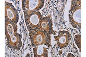 The image on the left is immunohistochemistry of paraffin-embedded Human colon cancer tissue using ABIN7191791(PARP8 Antibody) at dilution 1/40, on the right is treated with synthetic peptide. (PARP8 抗体)