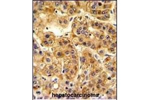 Formalin-fixed and paraffin-embedded human hepatocarcinoma reacted with SIL1 Antibody (Center), which was peroxidase-conjugated to the secondary antibody, followed by DAB staining. (SIL1 抗体  (AA 99-126))