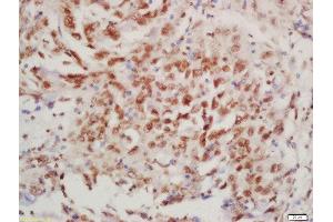 Formalin-fixed and paraffin embedded human lung carcinoma labeled with Rabbit Anti-BTK (Tyr223) Polyclonal Antibody, Unconjugated  at 1:200 followed by conjugation to the secondary antibody and DAB staining (BTK 抗体  (pTyr223))