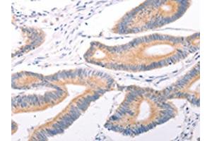 The image on the left is immunohistochemistry of paraffin-embedded Human colon cancer tissue using ABIN7131495(TRPC7 Antibody) at dilution 1/25, on the right is treated with fusion protein. (TRPC7 抗体)