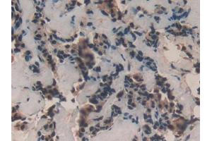DAB staining on IHC-P; Samples: Human Breast cancer Tissue