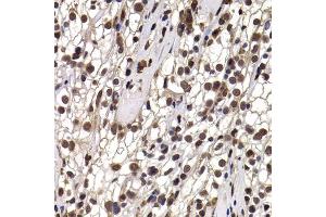 Immunohistochemistry of paraffin-embedded human kidney cancer using DDX21 antibody (ABIN5974230) at dilution of 1/100 (40x lens). (DDX21 抗体)