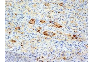 Formalin-fixed, paraffin-embedded human Erdheim-Chester disease (also known as polyostotic sclerosing histiocytosis) stained with TNF alpha Mouse Monoclonal Antibody (TNFA/1172). (TNF alpha 抗体)