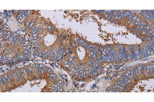 Immunohistochemistry of paraffin-embedded Human colon cancer using LIMS1 Polyclonal Antibody at dilution of 1:40 (LIMS1 抗体)