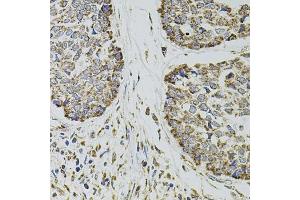 Immunohistochemistry of paraffin-embedded human esophageal cancer using CD62P/P-selectin antibody (ABIN6131514, ABIN6147503, ABIN6147506 and ABIN6218519) at dilution of 1:100 (40x lens). (P-Selectin 抗体  (AA 30-200))
