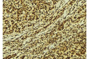 ABIN6269328 at 1/100 staining Human breast cancer tissue by IHC-P. (PKC delta 抗体  (C-Term))
