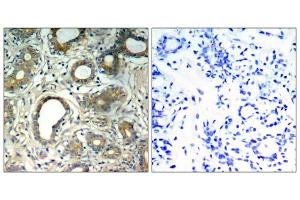 Immunohistochemical analysis of paraffin-embedded human breast carcinoma tissue, using SHP-2 (Phospho-Tyr580) antibody (E011320). (PTPN11 抗体  (pTyr580))