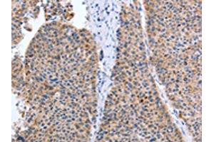 The image on the left is immunohistochemistry of paraffin-embedded Human liver cancer tissue using ABIN7131299(TAT Antibody) at dilution 1/35, on the right is treated with fusion protein. (Tat 抗体)