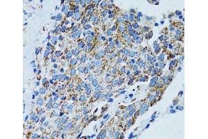 Immunohistochemistry of paraffin-embedded Human lung cancer using MRPL28 Polyclonal Antibody at dilution of 1:100 (40x lens). (MRPL28 抗体)