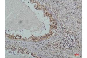 Immunohistochemistry (IHC) analysis of paraffin-embedded Human Lung Carcinoma using IkappaB beta(Mouse Monoclonal Antibody diluted at 1:200. (NFKBIB 抗体)