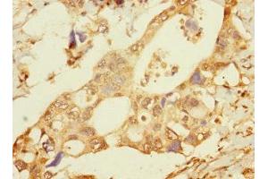 Immunohistochemistry of paraffin-embedded human pancreatic cancer using ABIN7165454 at dilution of 1:100 (FAM187B 抗体  (AA 18-335))