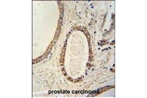 TME antibody (N-term) (ABIN654026 and ABIN2843945) immunohistochemistry analysis in formalin fixed and paraffin embedded human prostate carcinoma followed by peroxidase conjugation of the secondary antibody and DAB staining. (TMEM214 抗体  (N-Term))