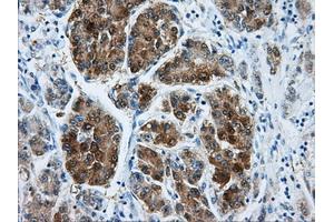 Immunohistochemical staining of paraffin-embedded Carcinoma of liver tissue using anti-DCXRmouse monoclonal antibody. (DCXR 抗体)