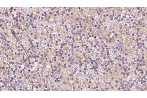 ABIN6273079 at 1/100 staining Human lymph cancer tissue by IHC-P. (SYVN1 抗体  (Internal Region))
