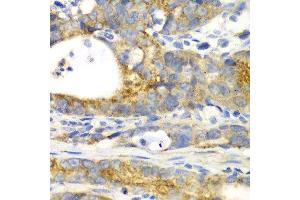 Immunohistochemistry of paraffin-embedded human gastric cancer using GORASP1 antibody at dilution of 1:100 (x40 lens). (GORASP1 抗体)