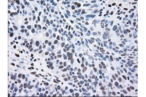 Immunohistochemical staining of paraffin-embedded Adenocarcinoma of breast tissue using anti-MAP2K2 mouse monoclonal antibody. (MEK2 抗体)