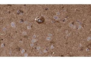 ABIN6273476 at 1/100 staining Human brain cancer tissue by IHC-P.