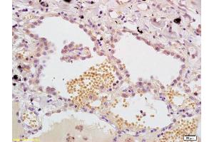 Formalin-fixed and paraffin embedded human lung carcinoma labeled with Anti- MASP Polyclonal Antibody, Unconjugated (ABIN733508) at 1:200, followed by conjugation to the secondary antibody and DAB staining. (MASP1 抗体  (AA 20-120))