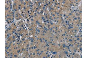The image on the left is immunohistochemistry of paraffin-embedded Human liver cancer tissue using ABIN7191867(PHKG1 Antibody) at dilution 1/20, on the right is treated with synthetic peptide. (PHKG1 抗体)