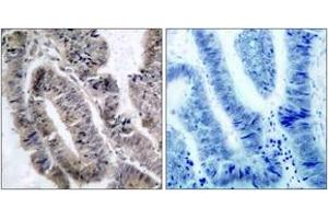 Immunohistochemistry analysis of paraffin-embedded human colon carcinoma, using AMPK1 (Phospho-Ser485) Antibody. (PRKAA1 抗体  (pSer496))
