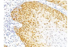 Formalin-fixed, paraffin-embedded human Cervical Cancer stained with p27 Monoclonal Antibody (DCS-72. (CDKN1B 抗体)