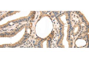 Immunohistochemistry of paraffin-embedded Human thyroid cancer tissue using TRIB3 Polyclonal Antibody at dilution 1:40 (TRIB3 抗体)