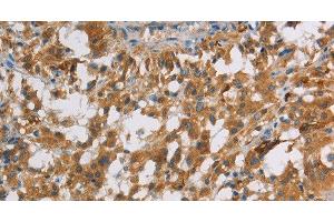 Immunohistochemistry of paraffin-embedded Human thyroid cancer using DBH Polyclonal Antibody at dilution of 1:70 (DBH 抗体)