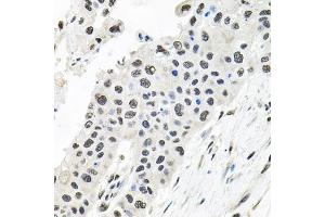 Immunohistochemistry of paraffin-embedded human lung cancer using CDC antibody (ABIN6127612, ABIN6138273, ABIN6138274 and ABIN6216282) at dilution of 1:100 (40x lens). (CDCA8 抗体  (AA 1-280))