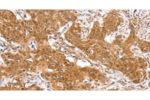 Immunohistochemistry of paraffin-embedded Human cervical cancer using RGS22 Polyclonal Antibody at dilution of 1:40 (RGS22 抗体)