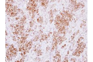IHC-P Image Immunohistochemical analysis of paraffin-embedded human breast cancer, using HLA-DMA, antibody at 1:250 dilution. (HLA-DMA 抗体)