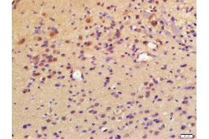 Formalin-fixed and paraffin embedded labeled with Rabbit Anti-LPCAT2 Polyclonal Antibody, Unconjugated (ABIN2177389) at 1:200 followed by conjugation to the secondary antibody and DAB staining (LPCAT2 抗体  (AA 131-230))