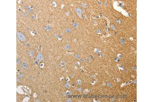 Immunohistochemistry of Human colon cancer using SLC4A4 Polyclonal Antibody at dilution of 1:50 (SLC4A4 抗体)