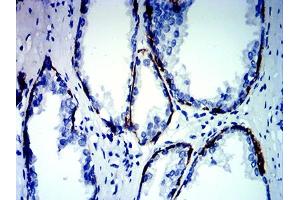 Immunohistochemical analysis of paraffin-embedded prostate cancer tissues using KRT13 mouse mAb with DAB staining. (Cytokeratin 13 抗体  (AA 104-458))
