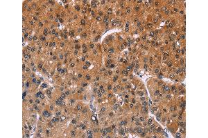 Immunohistochemistry of Human liver cancer using ING2 Polyclonal Antibody at dilution of 1:40 (ING2 抗体)