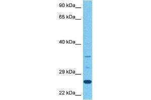 Host:  Rabbit  Target Name:  STEAP1  Sample Tissue:  Human Stomach Tumor  Antibody Dilution:  1ug/ml (STEAP1B 抗体  (N-Term))