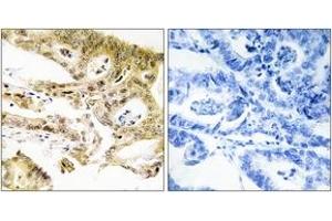 Immunohistochemistry analysis of paraffin-embedded human colon carcinoma tissue, using MED23 Antibody. (MED23 抗体  (AA 1-50))