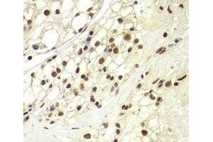 Immunohistochemistry of paraffin-embedded Human kidney cancer using RPA2 Polyclonal Antibody at dilution of 1:100 (40x lens). (RPA2 抗体)