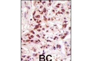 Formalin-fixed and paraffin-embedded human cancer tissue reacted with the primary antibody, which was peroxidase-conjugated to the secondary antibody, followed by DAB staining. (MAP3K8 抗体  (C-Term))