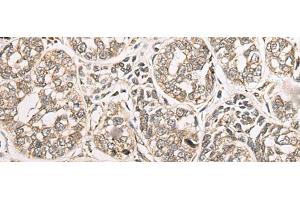 Immunohistochemistry of paraffin-embedded Human esophagus cancer tissue using COA7 Polyclonal Antibody at dilution of 1:55(x200) (C1orf163 抗体)