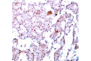 Immunohistochemistry of paraffin-embedded human breast carcinoma using Phospho-RELA-S536 antibody (ABIN2987368). (NF-kB p65 抗体  (pSer536))