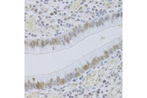 Immunohistochemistry of paraffin-embedded human gastric cancer using JMJD6 Antibody (ABIN5973452) at dilution of 1/100 (40x lens). (JMJD6 抗体)