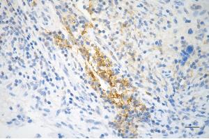 Immunohistochemistry was performed on paraffin-embedded human breast carcinoma using STAT5A antibody (ABIN7800347), 1:200). (Recombinant STAT5A 抗体)