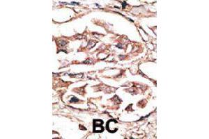 Formalin-fixed and paraffin-embedded human cancer tissue reacted with DKK2 polyclonal antibody  , which was peroxidase-conjugated to the secondary antibody, followed by AEC staining. (DKK2 抗体  (C-Term))