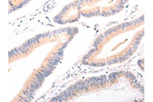 The image on the left is immunohistochemistry of paraffin-embedded Human colon cancer tissue using ABIN7189634(ACR Antibody) at dilution 1/20, on the right is treated with synthetic peptide. (Acrosin 抗体)