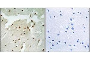 Immunohistochemistry analysis of paraffin-embedded human lung carcinoma, using Ku70 (Phospho-Ser5) Antibody. (XRCC6 抗体  (pSer5))