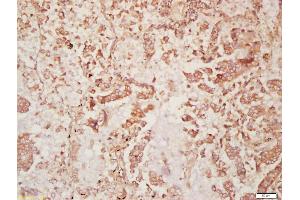 Formalin-fixed and paraffin embedded human lung carcinoma labeled with Anti-DISP2 Polyclonal Antibody, Unconjugated (ABIN1386087) at 1:200 followed by conjugation to the secondary antibody and DAB staining (DISP2 抗体  (AA 1101-1200))