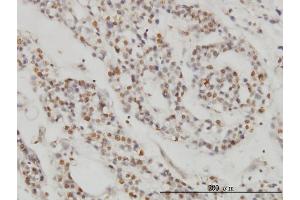 Immunoperoxidase of monoclonal antibody to DPF2 on formalin-fixed paraffin-embedded human ovary, clear cell carcinoma. (DPF2 抗体  (AA 56-155))