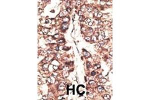Formalin-fixed and paraffin-embedded human cancer tissue reacted with the primary antibody, which was peroxidase-conjugated to the secondary antibody, followed by DAB staining. (MAGEA11 抗体  (N-Term))